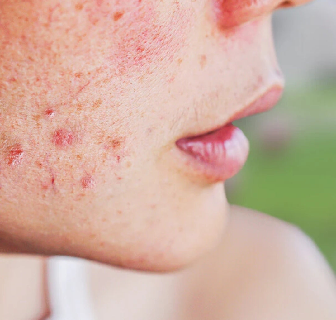 Acne- Prone Skincare