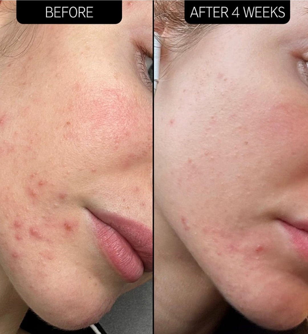 The INKEY List
SuperSolutions Acne Clearing Moisturizer 2% NOVORETINᵀᴹ