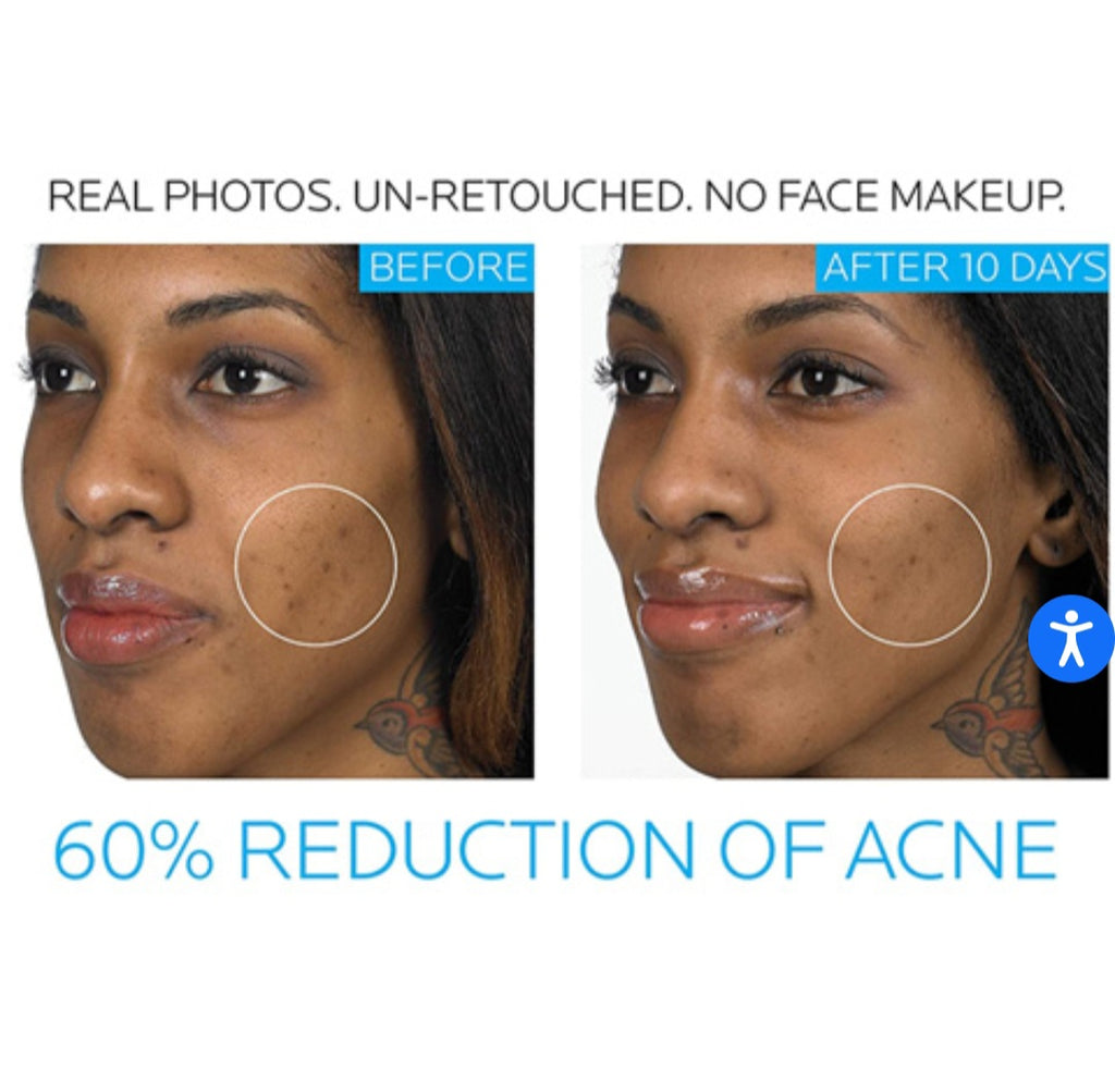 La Roche-Posay Effaclar Duo Acne Spot Treatment