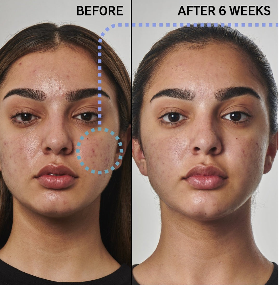 The INKEY List
Super Solutions 5% Benzoyl Peroxide Cleanser Acne Solution