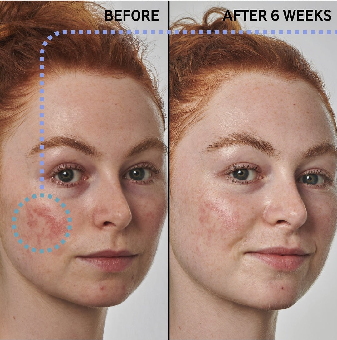 The INKEY List
SuperSolutions 10% Azelaic Serum Redness Relief Solution, 1 oz